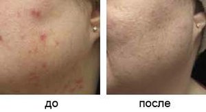 Фототерапия акне