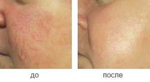 Лечение купероза и розацеи