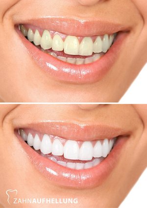  Отбеливание зубов