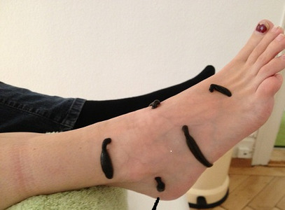 Therapie mit Blutegeln