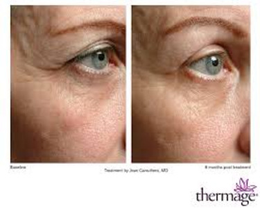 Thermage