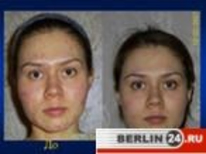 До и после чистки лица с использованием фруктовых кислот (хим. пилинг)
