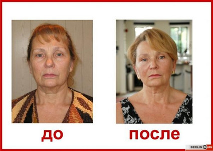 После комплекса процедур радиофриквенц вместе с мезотерапией и хим. пилингами